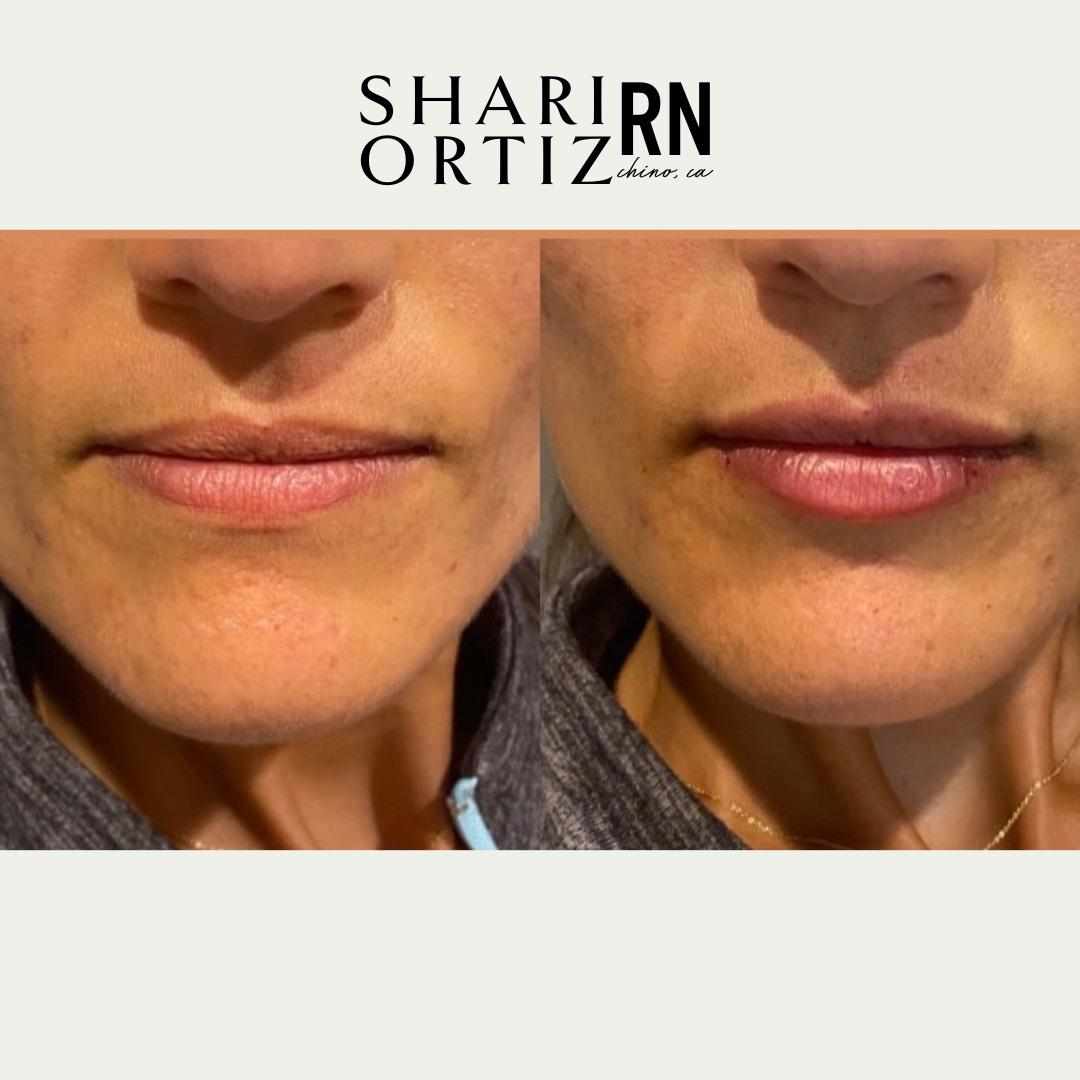 Botox & Fillers Services Chino, CA Bronzed Beauty Bar