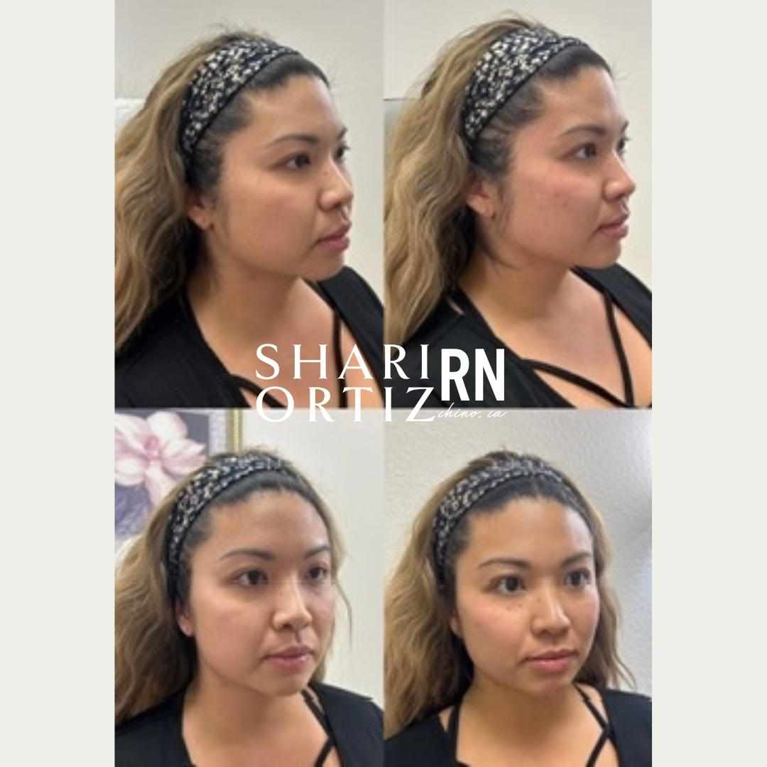 Botox & Fillers Services Chino, CA Bronzed Beauty Bar